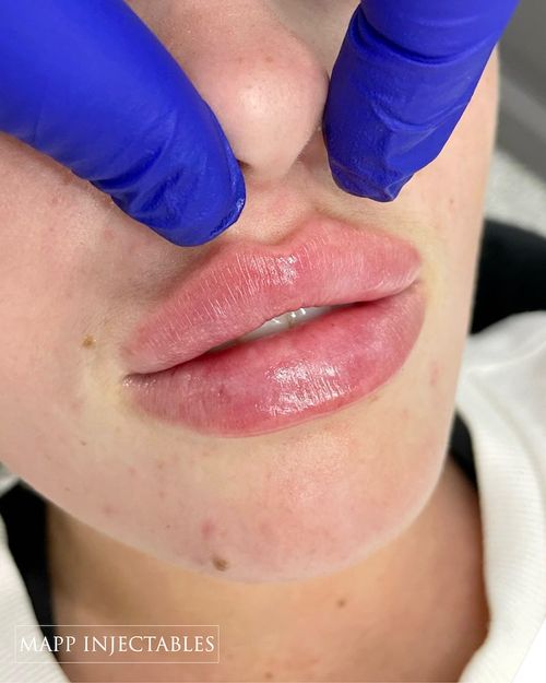 Lip Filler Photos High quality video and photos of our results